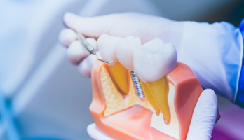 Benefits of Choosing Dental Implants for Missing Teeth in New York